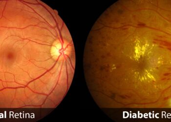 Do diabetes, diabetic retinal disease contribute to macular degeneration?