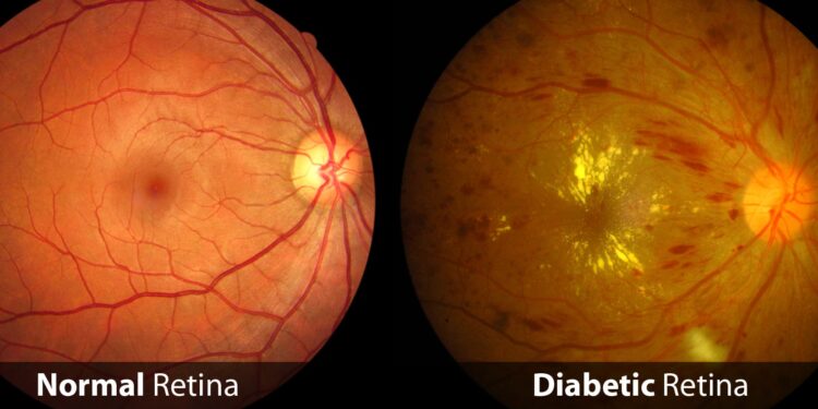 Do diabetes, diabetic retinal disease contribute to macular degeneration?