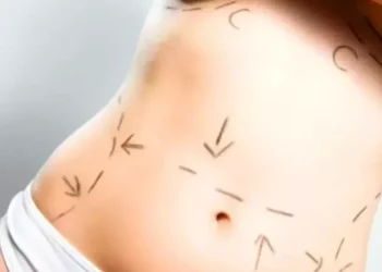 Effect of the recession on plastic surgery practices