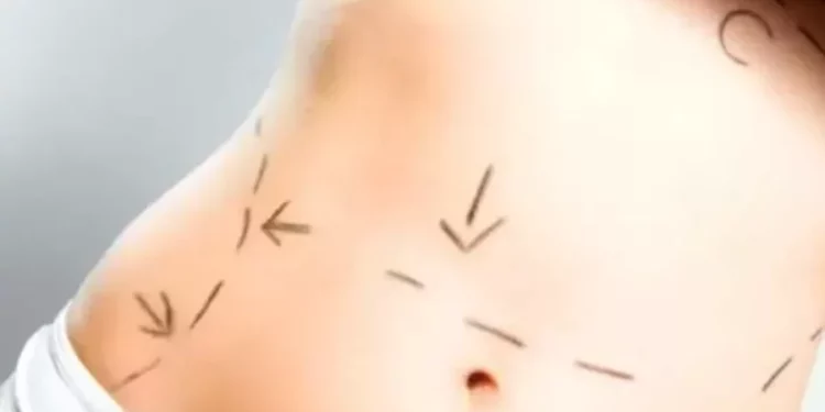 Effect of the recession on plastic surgery practices