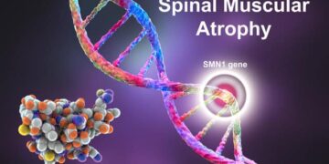 Rare diseases – spinal muscular atrophy